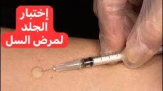 إختبار الجلد لمرض السل Tuberculin Skin Test [upl. by Utham894]