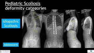 NonAIS Scoliosis Whats the difference [upl. by Lynda]