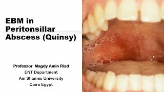 EBM in Peritonsillar Abscess Quinsy [upl. by Menendez]