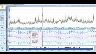 Einführung in die Auswertung eines LangzeitEKGs mit Medilog Darwin 2 [upl. by Michaeu]
