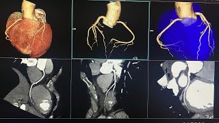 CTA CORONARY  Siemens 128 Somatom goTop  65 ml Contrast flow rate 55 mls HMS MIRDIF HOSPITAL [upl. by Esmerolda]