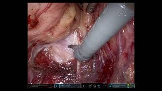 daVinci distal rectal cancer surgery with original audio [upl. by Devol]