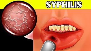 Syphilis  Causes Signs amp Symptoms Pathogenesis Diagnosis And Treatment [upl. by Eerrahs]