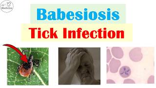 Babesiosis Infection From Tick Bite  Pathophysiology Symptoms Diagnosis Treatment [upl. by Amak]