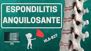 ESPONDILITIS ANQUILOSANTE ¿Qué es realmente [upl. by Harifaz]