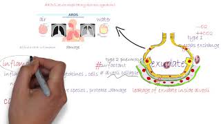 ARDS acute respiratory distress syndromeشرح [upl. by Brody952]