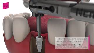 Insertion depth of a Zeramex XT implant [upl. by Ferrick]