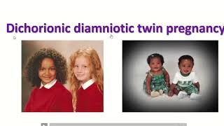 Anatomy of dichorionic and diamniotic twin pregnancy with sonographic feature twin obimagesnet [upl. by Bassett]