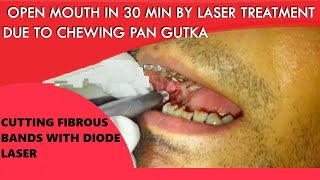 Laser Cutting of Fibrous Band of OSMF Patient ORAL SUBMUCOUS FIBROSIS TREATMENT [upl. by Tteve]