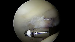 Articular Cartilage with a Grade 3 Injury to the Posterior Acetabulum near full thickness [upl. by Pietra388]