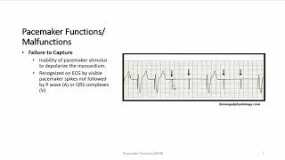 Pacemaker Overview [upl. by Raimondo]