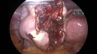 hemorrhagic ovarian cyst [upl. by Jareb]