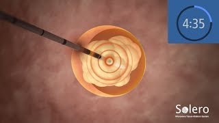 AngioDynamics Solero Microwave Tissue Ablation System Animation [upl. by Ahseihs919]