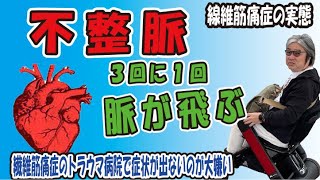 不整脈が出ました。病院に行って異常なしと言われるのが、トラウマ。皆さんは、すぐに病院に行ってください。 [upl. by Lynelle363]