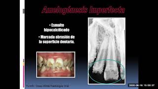 Clase de Anomalias dentarias [upl. by Lesde996]