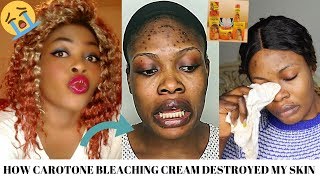 STORYTIME HOW CAROTONE BLEACHING CREAM DESTROYED MY SKIN😭😭 [upl. by Merry]