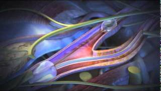 Angioplasty Stenting Atherectomy and Thrombolysis [upl. by Eybbob]