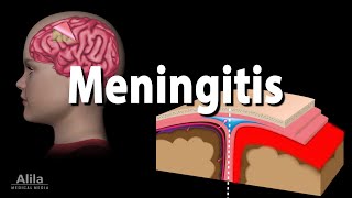 Meningitis Pathology Causes Symptoms Diagnosis and Treatment Animation [upl. by Ilehs393]