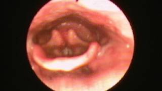 Fiberoptic Endoscopic Evaluation of Swallowing FFES example [upl. by Wilfreda]