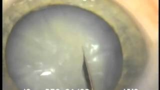 Conversion of a Canopener capsulotomy using twostaged CCC [upl. by Muhan]