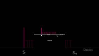 Holosystolic murmur [upl. by Divan]