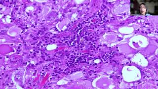 Tip39Ganglioglioma [upl. by Nivi779]