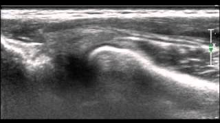 Ultrasonographic diagnosis of snapping annular ligament in the elbow [upl. by Irrabaj378]