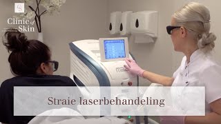 Striae laserbehandeling [upl. by Ramey]