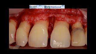 Periodontal Surgery Upper Front Teeth [upl. by Xino]