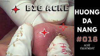 018  Super BIG acne all over the face  Mụn siêu to khắp mặt  Hương Đà Nẵng  akne Behandlung [upl. by Rudwik]