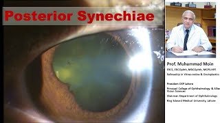 Post Synechiae in Uveitis [upl. by Newell]