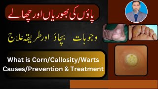 What is wartCallosityCorn on sole of foot its causes amp treatment options available [upl. by Kit]