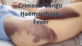 Crimean Congo Haemorrhagic Fever [upl. by Ecirp]