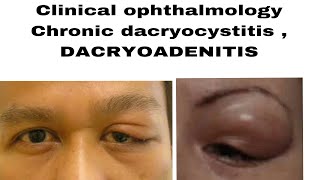 Clinical ophthalmology chronic dacryocystitis DACRYOADENITIS acute and chronic in easiest way [upl. by Alyhs]