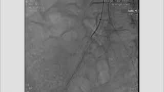 VID 6 ANTEROGRADE AORTO ILIAC RECANALIZATION THROUGH THE AXILLARY APROACH [upl. by Seleta784]