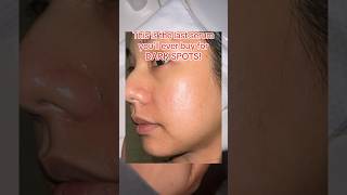 Best combo for Dark spots and Acne scars [upl. by Naleag]