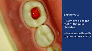 Pulpotomy of Deciduous Molar  QMUL [upl. by Sufur]