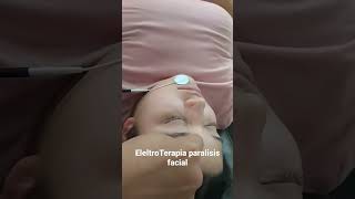 electroterapia para parálisis facial [upl. by Shena362]