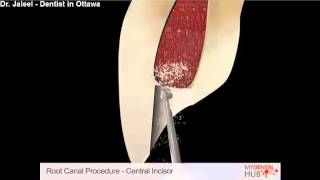 Endodontics  Root Canal Procedure Central Incisor  Dentist Ottawa [upl. by Harak]