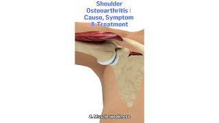 Causes And Cures For Shoulder Osteoarthritis [upl. by Avle518]