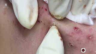 Big Cystic Acne Blackheads Extraction Blackheads amp Milia Whiteheads Removal Pimple Popping [upl. by Nyral]