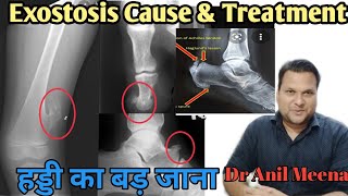 Exostosis Treatment  Exostosis cause and treatment  Osteochndroma  Osteophyte  Osteoma In Hindi [upl. by Notyal]