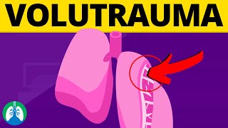 Volutrauma Medical Definition  Quick Explainer Video [upl. by Yllatan]