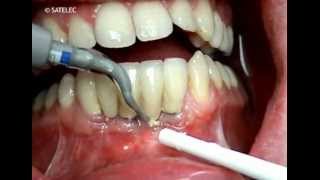 Dental Prosthetic amp Implant Maintenance PH2R and PH2L Tips [upl. by Bradski]