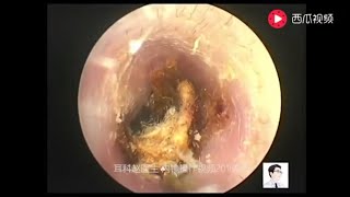 Earwax Removal Extraction Cholesteatoma of the middle ear canal exfoliate of tympanic membrane [upl. by Ecirted21]