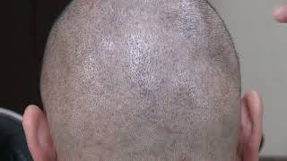 FUE Donor Area of Male Patient in Medical Hair Transplant Clinic [upl. by Sehcaep]