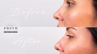 Plasma Fibroblast  Prive Academy  Nose Contouring Technique [upl. by Otir181]