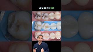 Why are simple direct restorations the most important in Biomimetic dentistry 🤔 dentist dental [upl. by Culver]