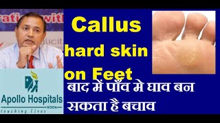 Callus Callosity Hard Skin on Feet in Diabetes lead to Diabetic Foot Ulcer Cause Treatment Prevent [upl. by Adnohsar498]