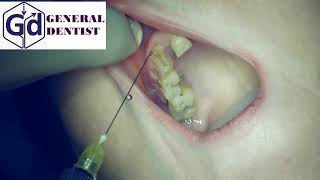 Infiltration anesthesia for extraction 12 tooth [upl. by Novaat5]